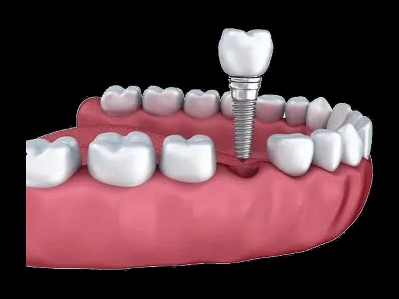Имплантация (Dentium SuperLine, Корея)